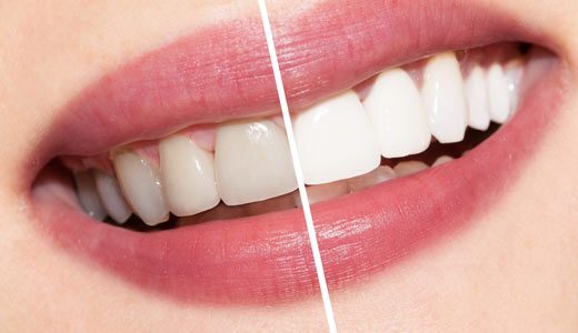 Professional whitening