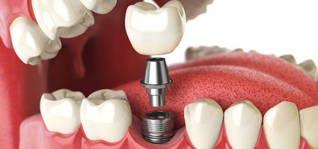 Difference Between Dentures and Dental Implants