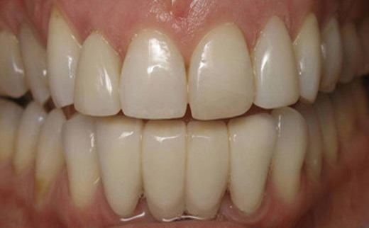 1-Dental-Bridge-and-Composite-Veneers-after