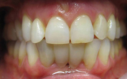 1-Dental-Bridge-and-Composite-Veneers-before