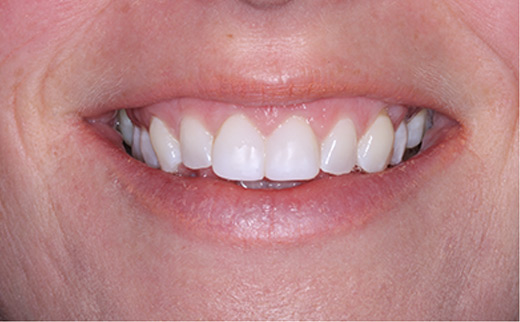 porcelain veneers gold coast