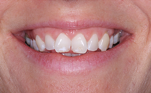 veneers gold coast