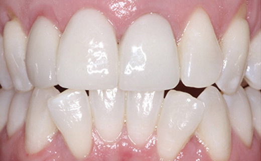 porcelain veneers