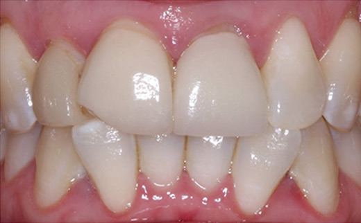 veneers gold coast