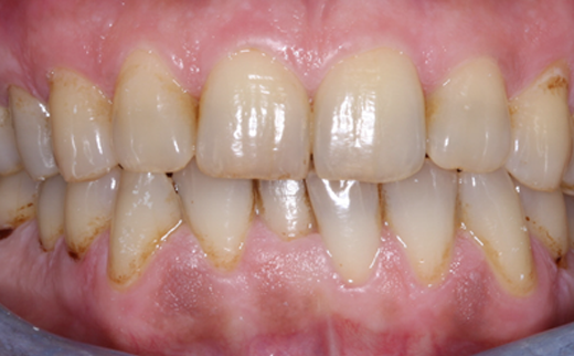 Dental Bridges Gold Coast