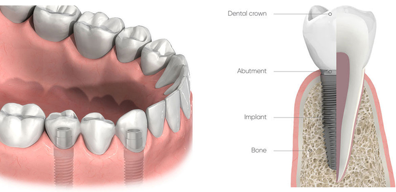 dental implants gold coast