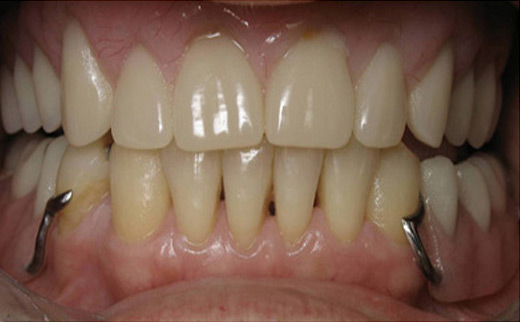 Loose-Tooth-and-Gum-Disease-after