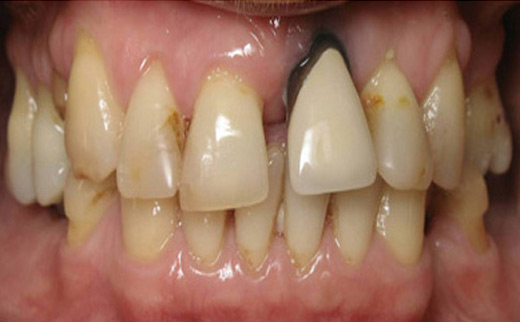 Loose-Tooth-and-Gum-Disease-before