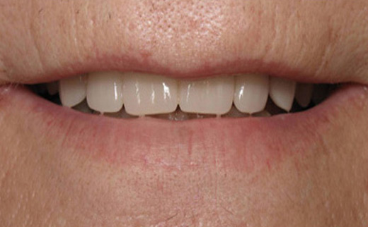 Tooth-Replacement-after