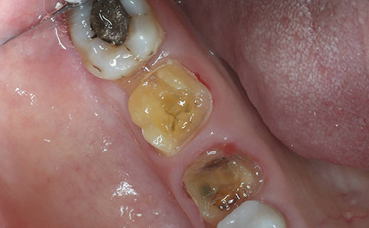 dentures gold coast